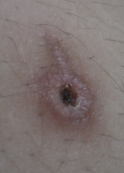 scab - scab -